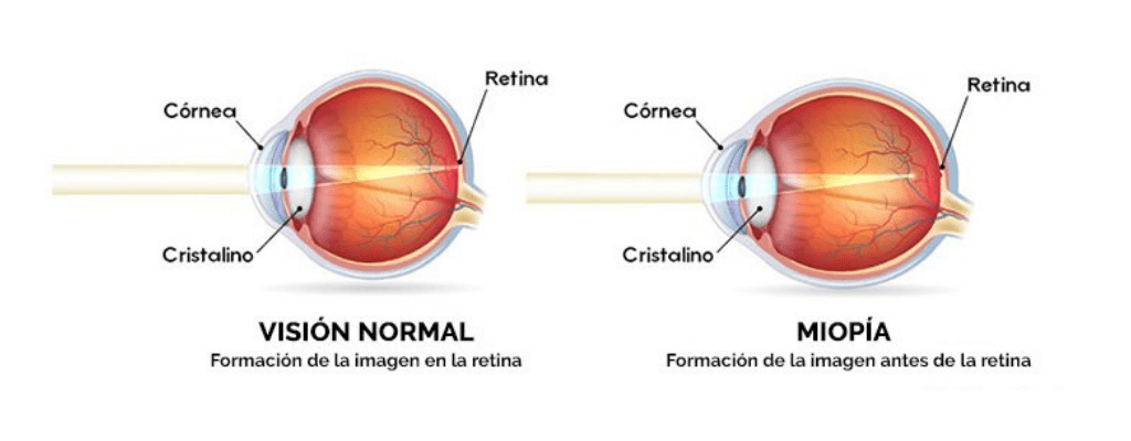 visión normal vs miopía