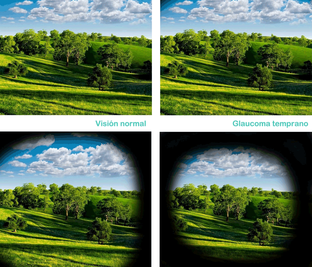 Evolución de la vista a causa del glaucoma