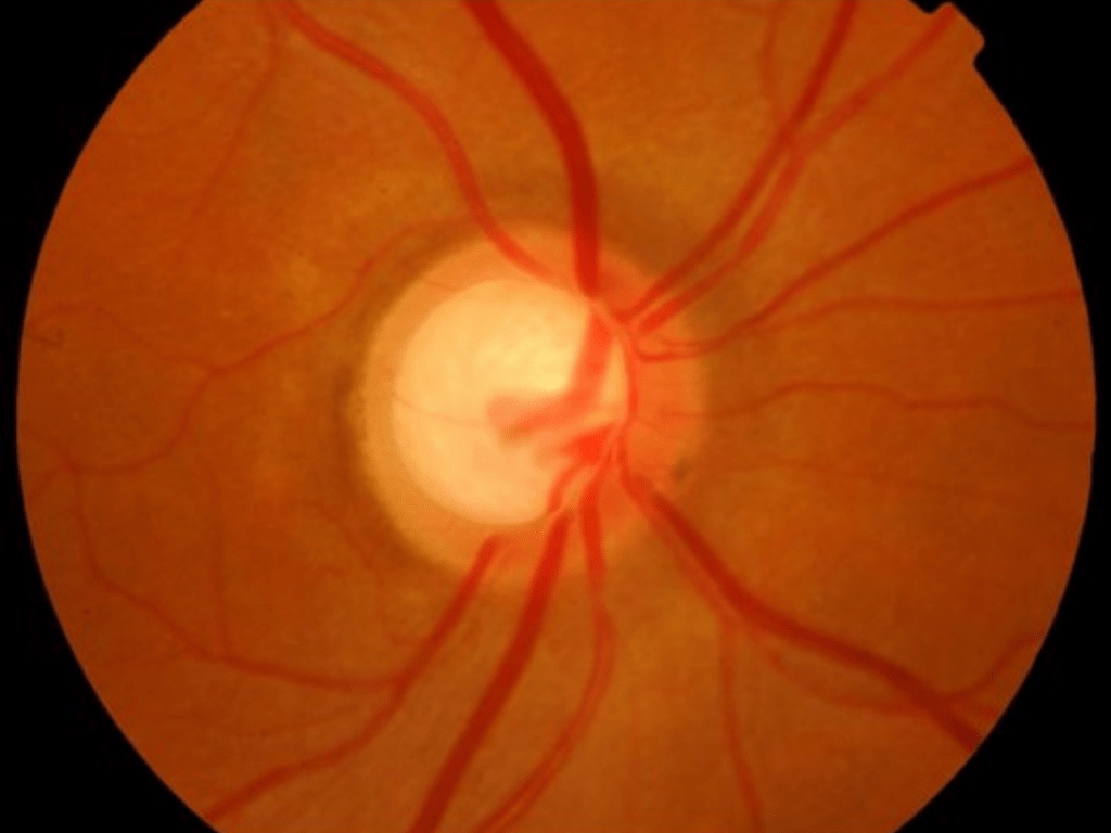Nervio óptico con glaucoma